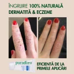Puradoro Cremă Anti-Dermatită & Eczeme – Naturală, Calmează Iritațiile, Reduce Roșeața și Elimină Cojile 50ml - imagine 5